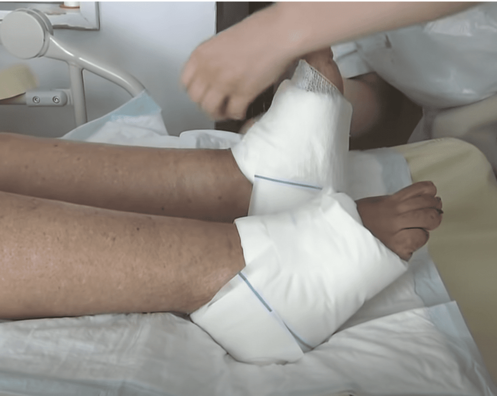 L'évaluation des stades de l'escarre est cruciale pour définir une stratégie de soins adaptée.