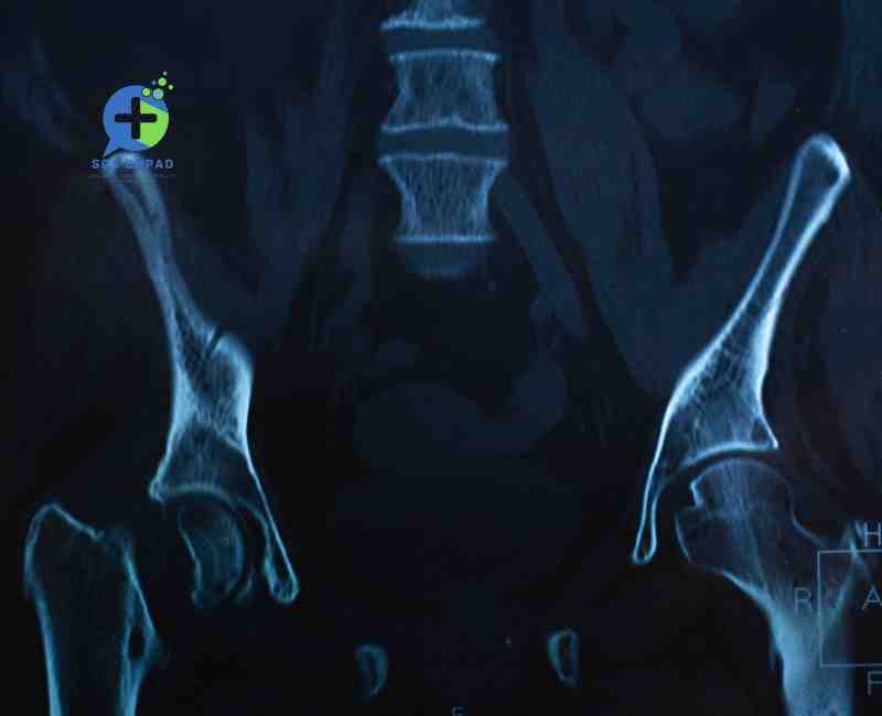 Fractures du col du fémur chez les seniors : Un défi