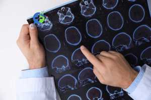 Facteurs déclenchants de la sclérose en plaques : Une analys